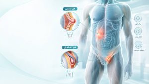 انواع فتق و علائم تشخیص